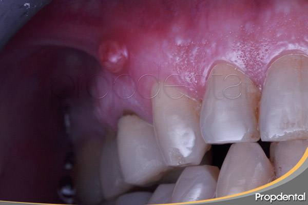 flemón dental