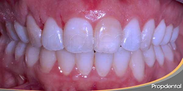 gingivoplastia
