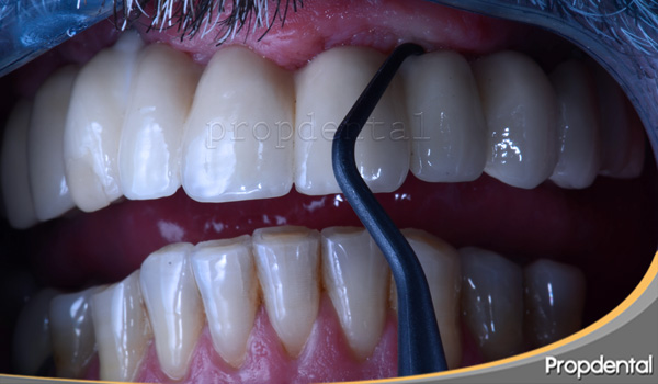 Limpieza e higiene y mantenimiento de la férula dental