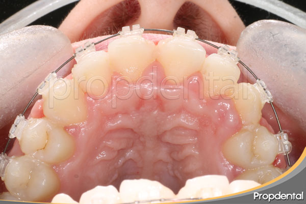 hiperplasia gingival