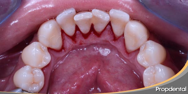 Credencial sinsonte Mismo Sarro dental ¿Por qué aparece sarro en los dientes y como tratar?