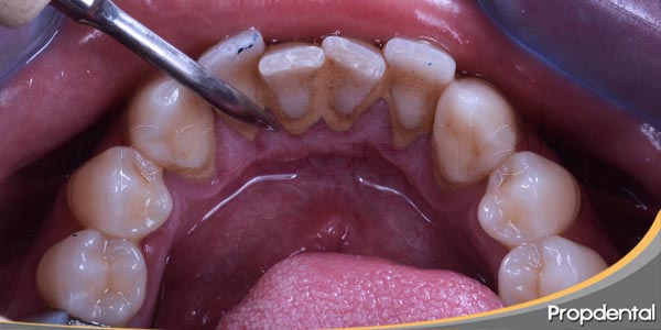 limpieza dental con ultrasonidos