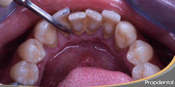 Credencial sinsonte Mismo Sarro dental ¿Por qué aparece sarro en los dientes y como tratar?