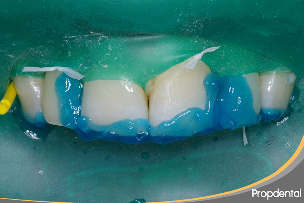 reconstrucción dental estética