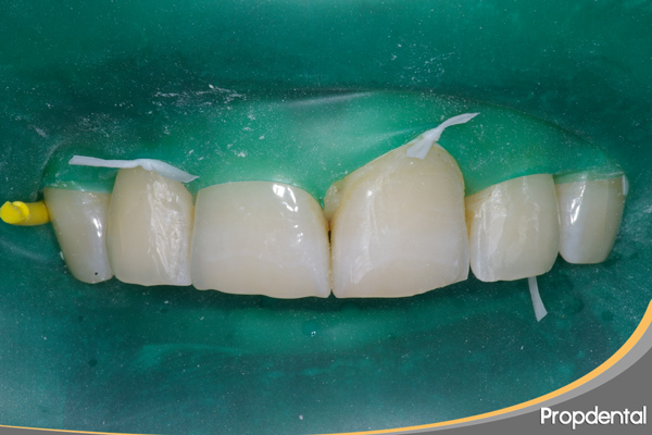 restauración dental con dique de goma