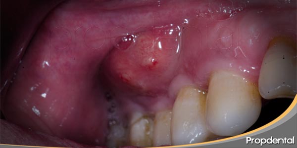 tipos de abscesos dentales periodontal o periapical