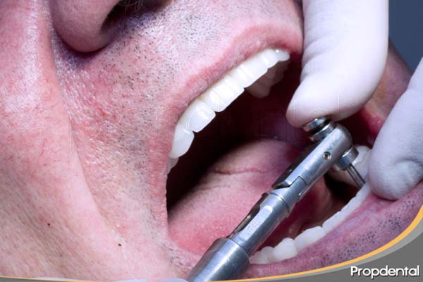 atornillado de prótesis implantosoportada con tornillos de titanio