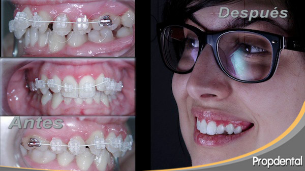 brackets de zafiro para alinear los dientes