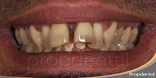 caso de prótesis dentales estéticas