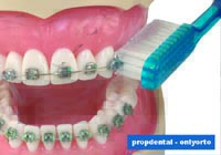 cepillado de los brackets dentales