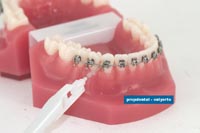 cepillo interproximal con aparatología fija