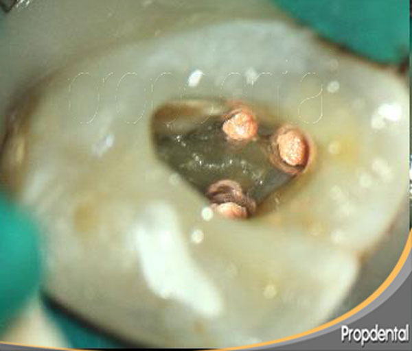 guta percha endodoncia