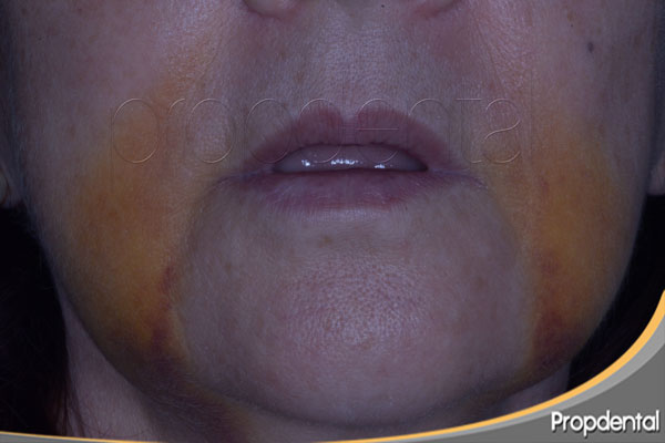 hematoma implantes dentales