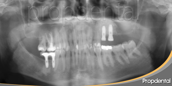 implantes después de la elevación de seno maxilar