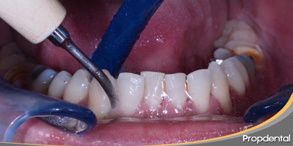 limpieza dental con ultrasonidos