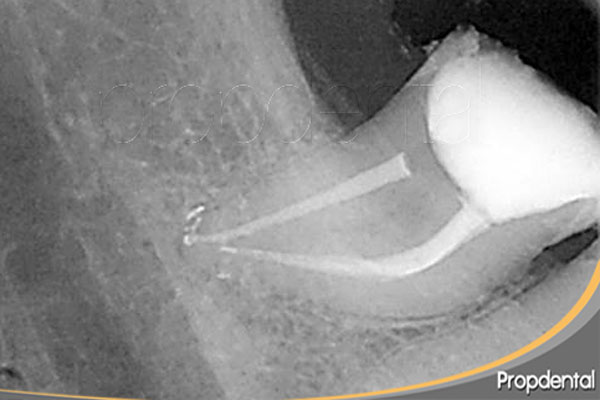 preguntas de endodoncia