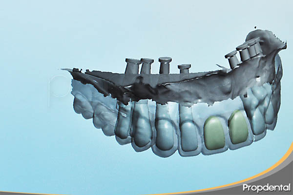 prótesis de circonio sobre implantes cadcam