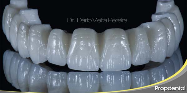 diseñar la sonrisa con implantes dentales