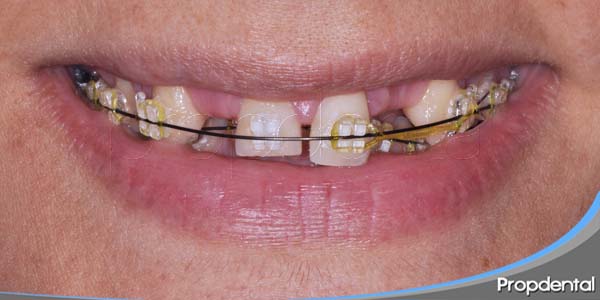ortodoncia e implantes dentales