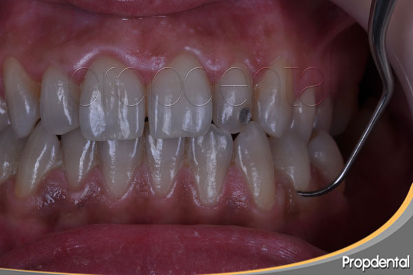 precio curetaje periodontal