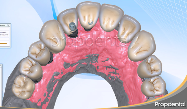 prótesis sobre implantes atornillada cadcam