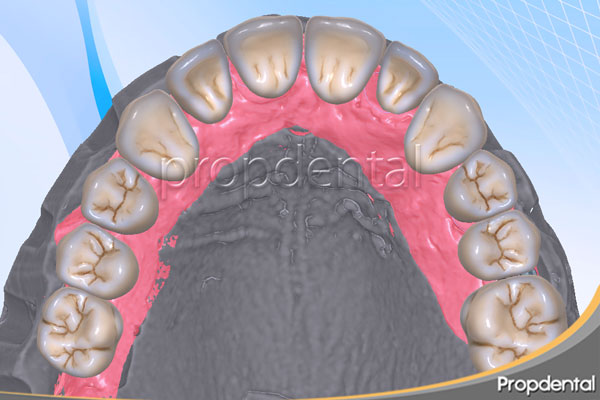 prótesis sobre implantes cementada cadcam
