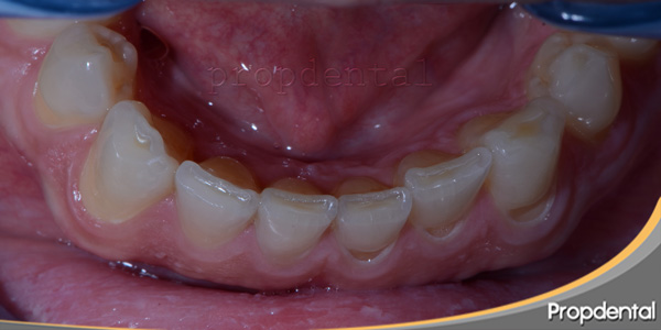 rechinamiento de los dientes