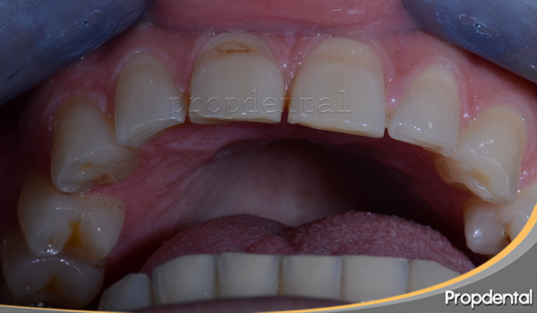 rechinar los dientes