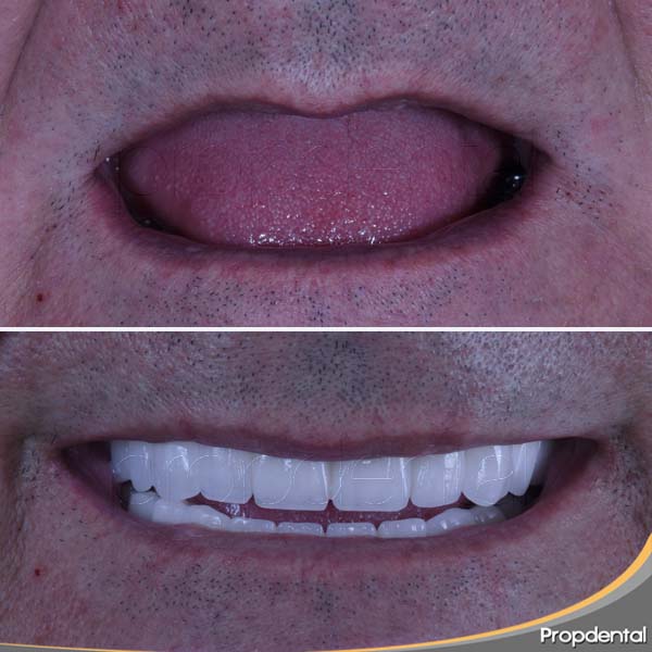 sonrisa con implantes dentales