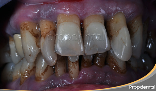 tratar la piorrea en Propdental