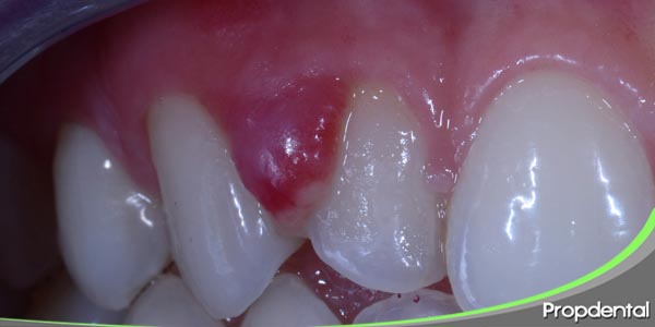 absceso periapical