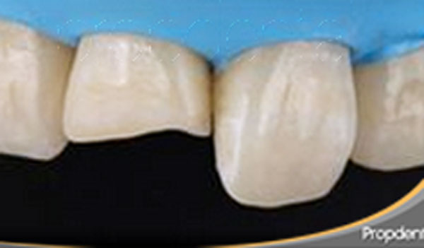 diente fracturado