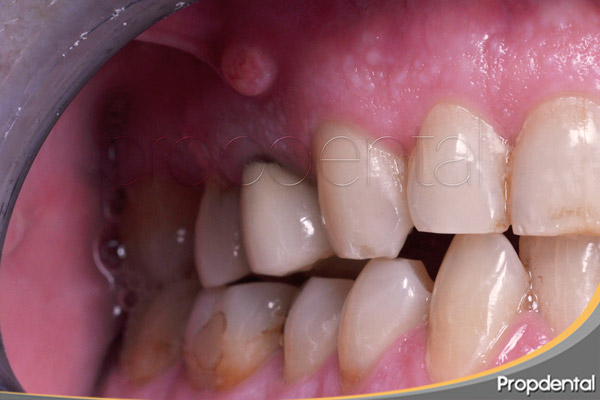 fístula dental