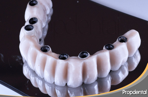 prótesis de metal porcelana sobre implantes dentales