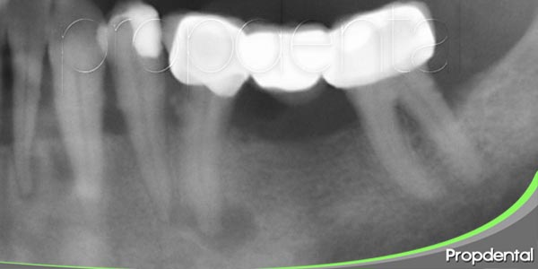quiste odontogenico