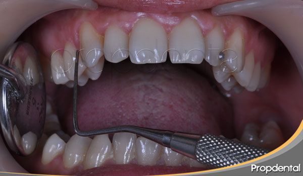 sondaje de diagnóstico periodontal