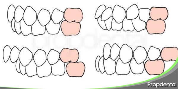 como prevenir las maloclusiones