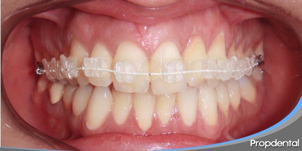 Ventajas e inconvenientes de los aparatos dentales