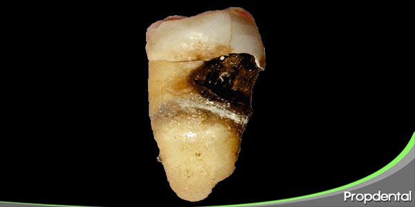 caries radicular
