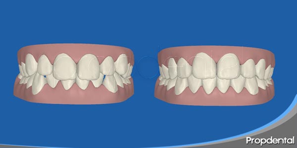 clincheck simulación tridimensional para invisalign