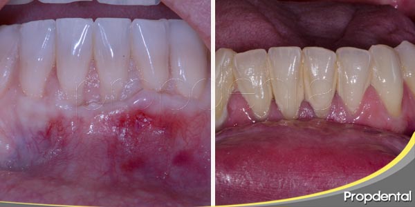 Cómo saber si tengo gingivitis y periodontitis? - Clínica Blasi