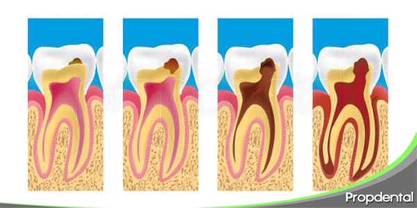 tipos de caries dental