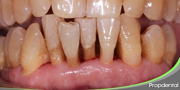 ¿Que es la enfermedad periodontal?