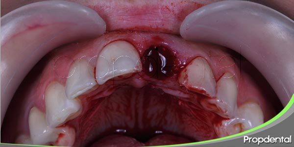 complicaciones de una extracción dental