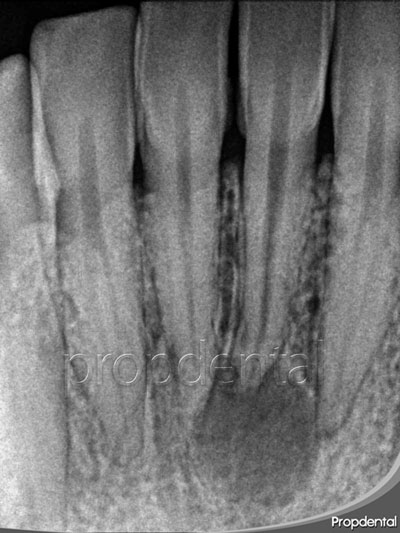 quiste periapical