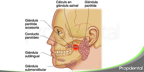 causas y síntomas de las piedras en las glándulas salivales