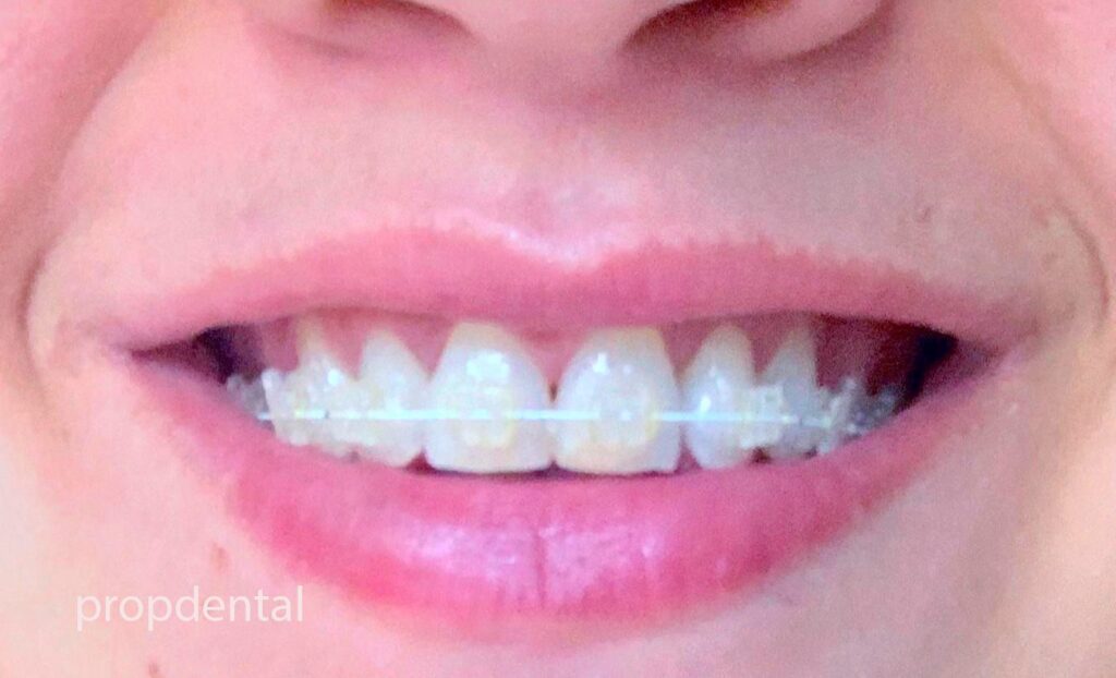 brackets de porcelana en Madrid y Barcelona