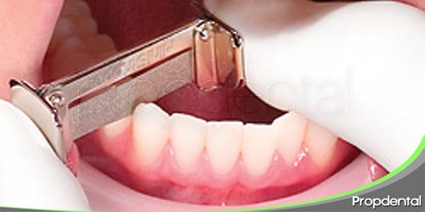 ¿Qué es el stripping dental en ortodoncia?