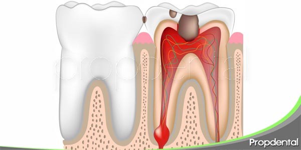 pulpitis, ¿qué es?