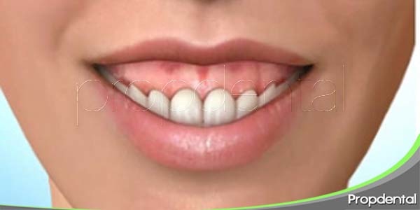 causas de la sonrisa gingival